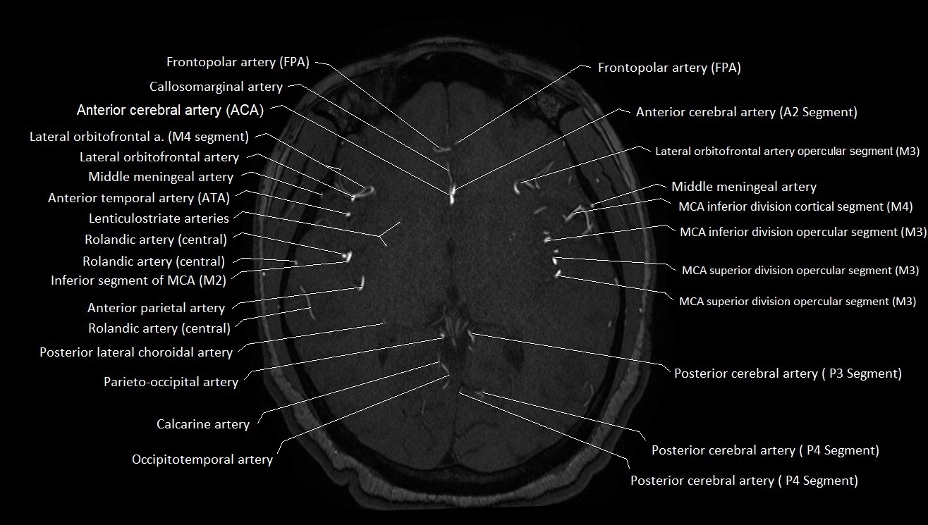 MRA brain (cerebral arteries) anatomy axial 3T image 26.webp